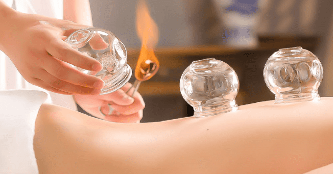 Ventouse - Cupping Thérapie - Hijama 